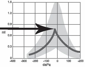 A diagram for plotting findings for tympanometry and acoustic