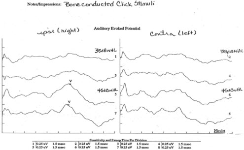 Automated cortical auditory evoked potentials threshold estimation in neonates