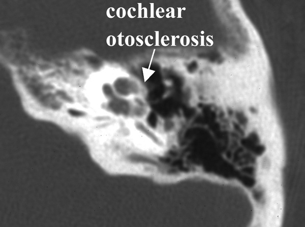 What Is Otosclerosis? Symptoms & Diagnosis